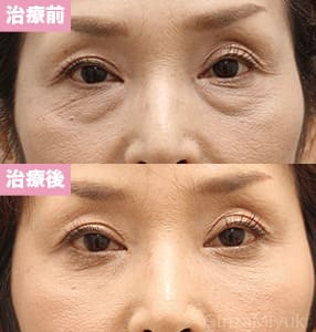 モニター症例№181（51歳 女性）脱脂コンデンスリポ