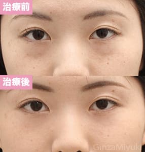 モニター症例№182（28歳 女性）脱脂ダブルリポ