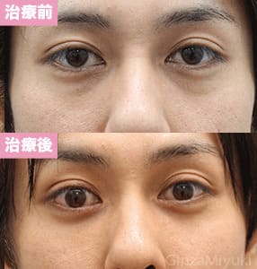 モニター症例№183（30歳 男性）脱脂コンデンスリポ