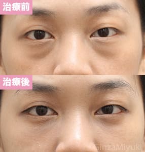 モニター症例№184（33歳 女性）脱脂コンデンスリポ