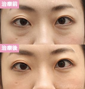 モニター症例№185（28歳 女性）脱脂コンデンスリポ