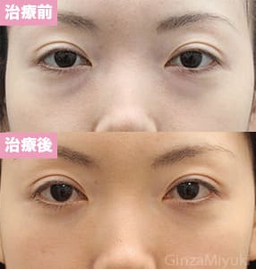 モニター症例№186（31歳 女性）脱脂コンデンスリポ