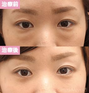 モニター症例№187（33歳 女性）脱脂コンデンスリポ