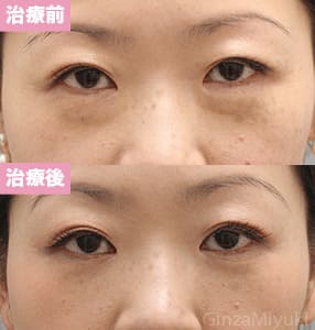 モニター症例№188（37歳 女性）脱脂コンデンスリポ