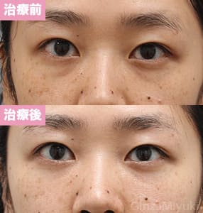 モニター症例№289（31歳 女性）脱脂ダブルリポ