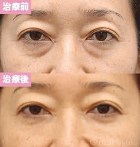 モニター症例№119（48歳 女性）脱脂コンデンスリポ