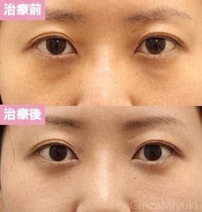 モニター症例№194（26歳 女性）脱脂コンデンスリポ