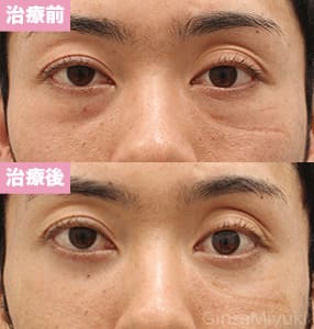 モニター症例№195（31歳 男性）脱脂コンデンスリポ