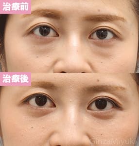 モニター症例№196（29歳 女性）脱脂コンデンスリポ