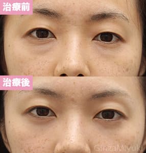 モニター症例№197（27歳 女性）脱脂コンデンスリポ