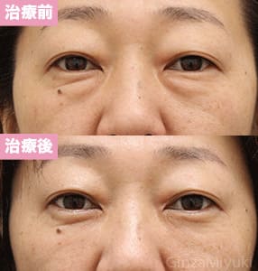 モニター症例№198（49歳 女性）脱脂コンデンスリポ