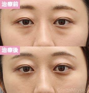 モニター症例№199（28歳 女性）脱脂コンデンスリポ