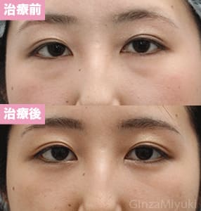 モニター症例№200（21歳 女性）脱脂コンデンスリポ