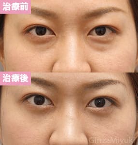 モニター症例№201（27歳 女性）脱脂コンデンスリポ