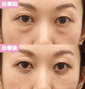 モニター症例№203（35歳 女性）脱脂コンデンスリポ