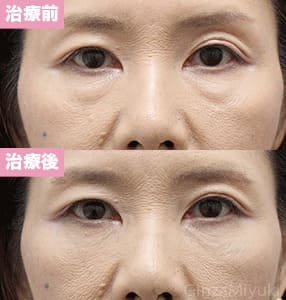 モニター症例№204（54歳 女性）脱脂コンデンスリポ