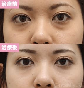 モニター症例№204（24歳 女性）脱脂コンデンスリポ