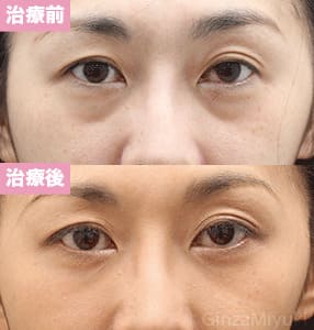 モニター症例№206（43歳 女性）脱脂ダブルリポ