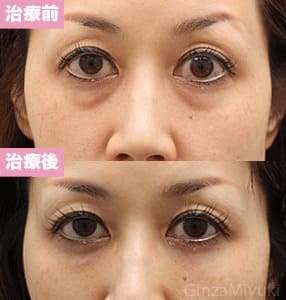 モニター症例№207（43歳 女性）脱脂コンデンスリポ