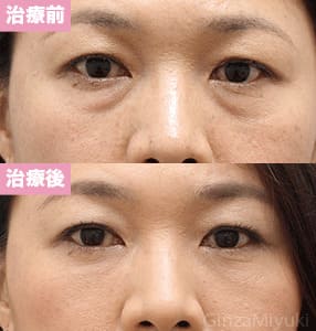 モニター症例№208（45歳 女性）脱脂ダブルリポ