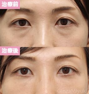 モニター症例№209（38歳 女性）脱脂コンデンスリポ