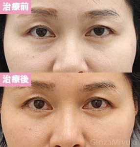 モニター症例№210（43歳 女性）脱脂ダブルリポ