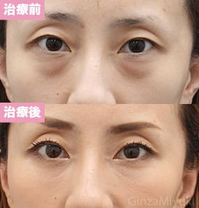 モニター症例№211（38歳 女性）脱脂コンデンスリポ