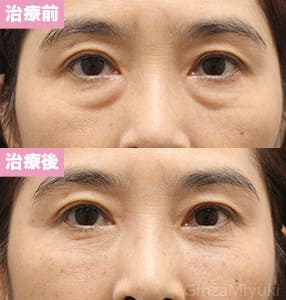 モニター症例№212（54歳 女性）脱脂コンデンスリポ