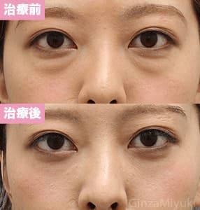 モニター症例№215（27歳 女性）脱脂ダブルリポ