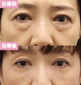 モニター症例№216（51歳 女性）脱脂コンデンスリポ