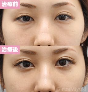 モニター症例№217（28歳 女性）脱脂コンデンスリポ