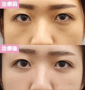 モニター症例№219（21歳 女性）脱脂ダブルリポ