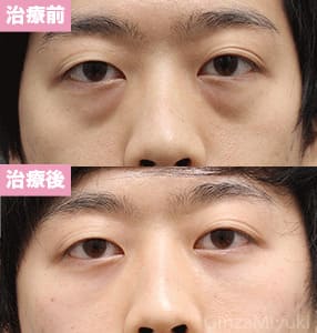 モニター症例№220（25歳 男性）脱脂コンデンスリポ