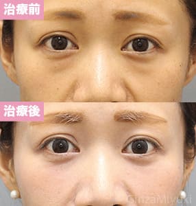 モニター症例№223（33歳 女性）脱脂コンデンスリポ