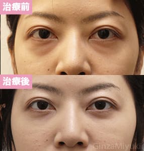 モニター症例№225（27歳 女性）脱脂コンデンスリポ