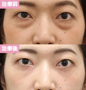 モニター症例№226（28歳 女性）脱脂コンデンスリポ