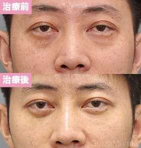 モニター症例№227（234歳 男性）脱脂コンデンスリポ