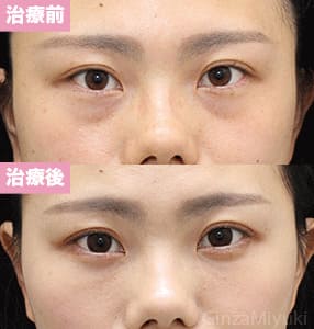 モニター症例№228（26歳 女性）脱脂コンデンスリポ