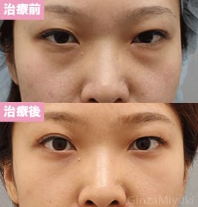 モニター症例№229（29歳 女性）脱脂コンデンスリポ