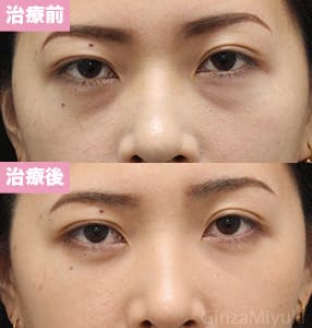 モニター症例№230（26歳 女性）脱脂コンデンスリポ