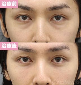 モニター症例№231（32歳 男性）脱脂コンデンスリポ