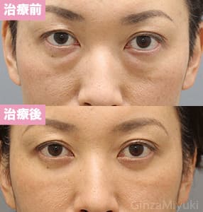 モニター症例№232（44歳 女性）脱脂コンデンスリポ