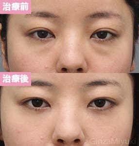 モニター症例№233（27歳 女性）脱脂コンデンスリポ