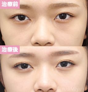 モニター症例№234（21歳 女性）脱脂コンデンスリポ