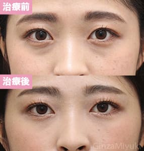 モニター症例№237（23歳 女性）脱脂コンデンスリポ