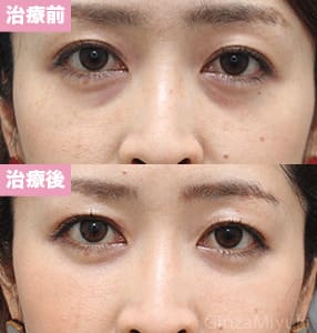 モニター症例№238（36歳 女性）脱脂コンデンスリポ