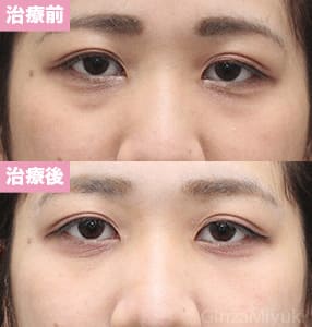 モニター症例№239（25歳 女性）脱脂コンデンスリポ