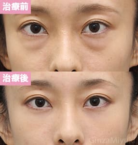 モニター症例№240（30歳 女性）脱脂コンデンスリポ