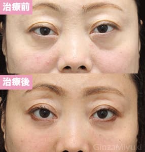 モニター症例№241（43歳 女性）脱脂コンデンスリポ