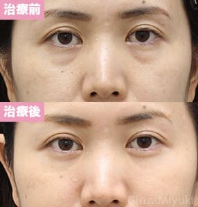 モニター症例№242（35歳 女性）脱脂コンデンスリポ